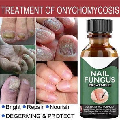 Nail Fungal Treatments Nail Repair Essences Serum Care Treatments Foot Nail Fungus Removal Gel